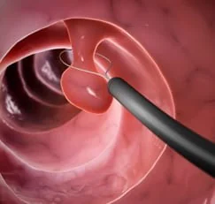 Bowel polyp removal