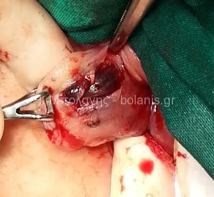 Hemorrhoids laser treatment - aimoroida thrombomeni 3