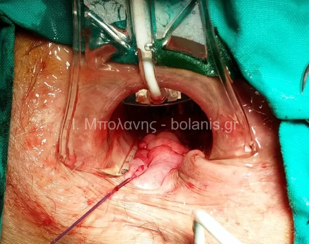 Hemorrhoids laser treatment - aimoroides 5 mines meta laser diorthosi me thd