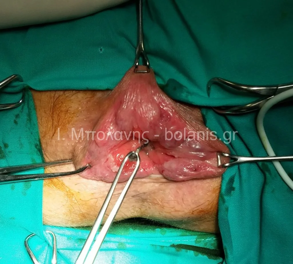 Hemorrhoids laser treatment - aimoroides 5 mines meta laser kai ramata