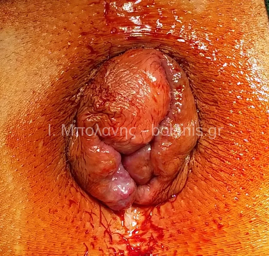 Hemorrhoids laser treatment - aimoroides epiplokes 30