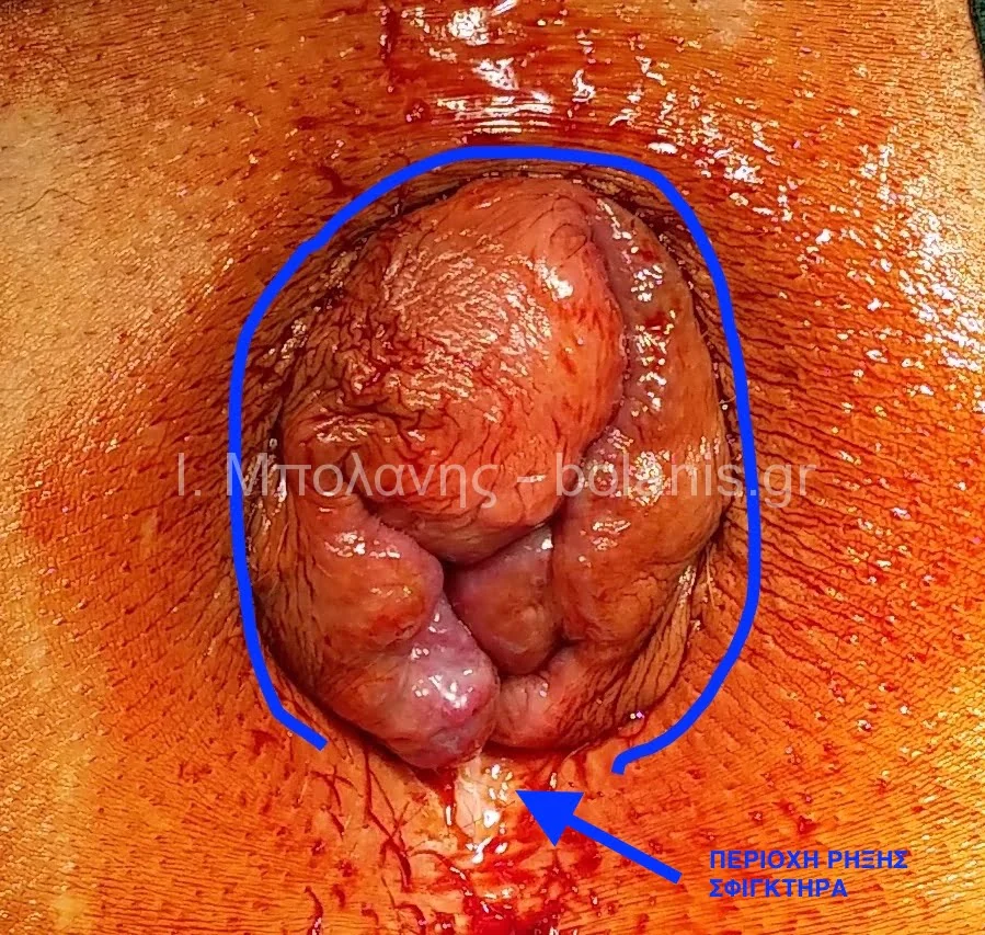 Hemorrhoids laser treatment - aimoroides epiplokes 30b