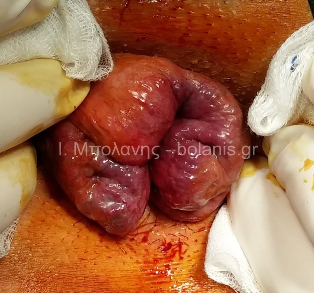 Hemorrhoids laser treatment - aimoroides epiplokes 31