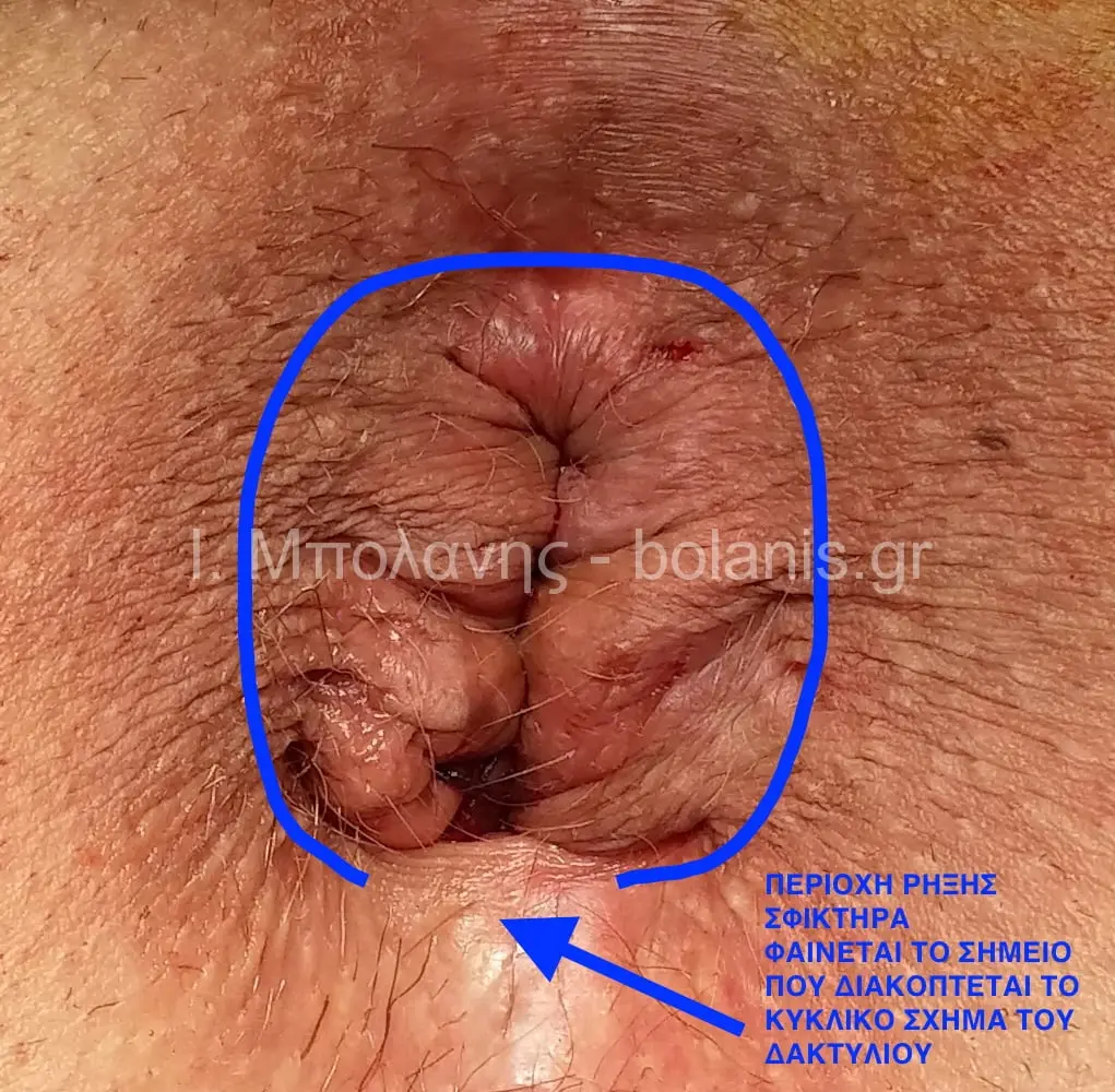 Hemorrhoids laser treatment - aimoroides epiplokes 32b