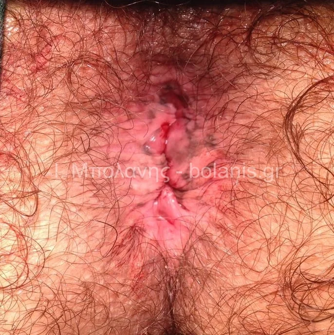 Hemorrhoids laser treatment - aimoroides meta 1