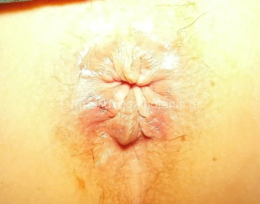 Hemorrhoids laser treatment - aimoroides meta 3