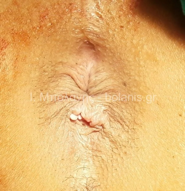 Hemorrhoids laser treatment - aimoroides meta 5