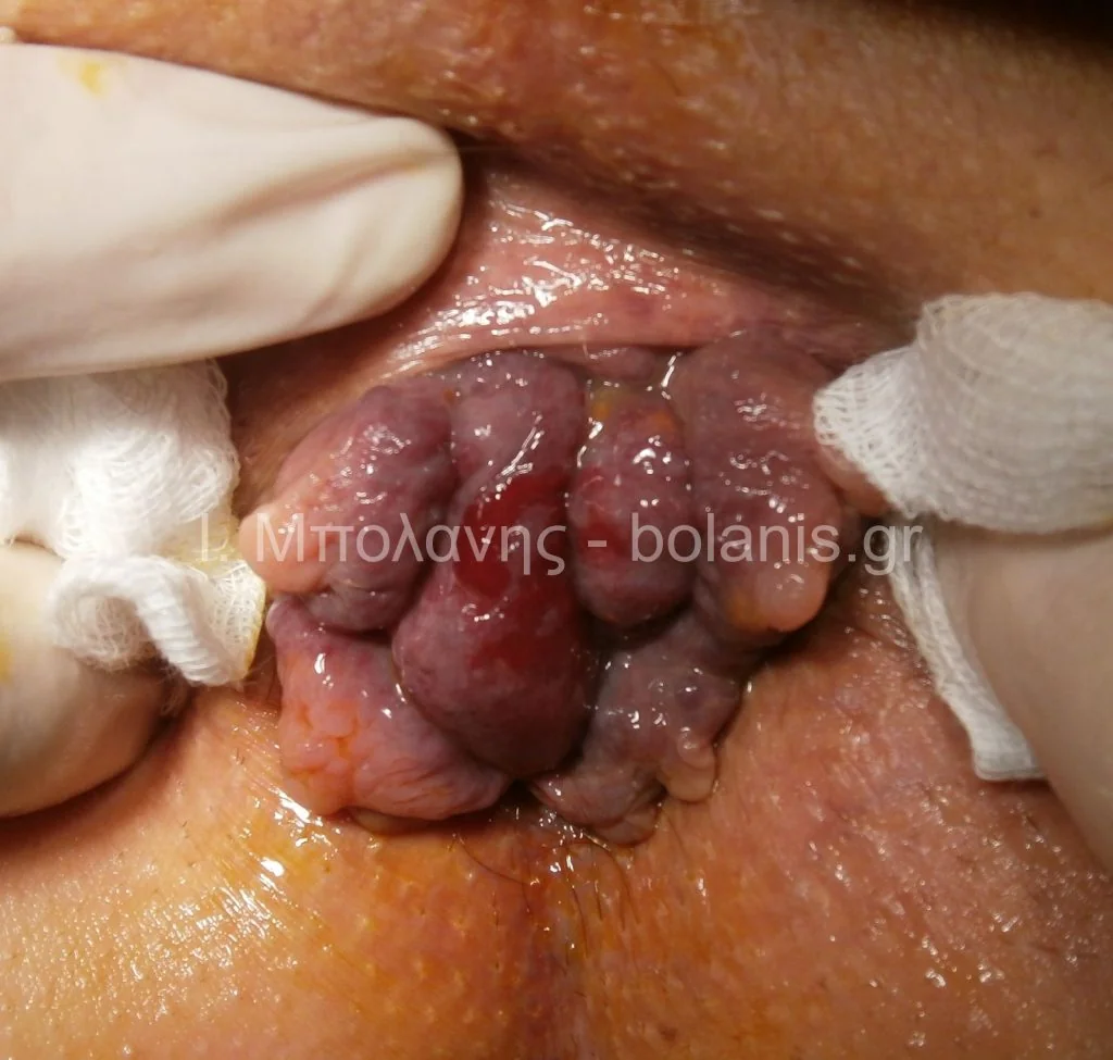 Hemorrhoids laser treatment - aimoroides prin 1