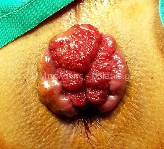 Hemorrhoids laser treatment - aimoroides prin 3