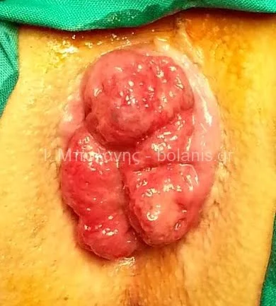Hemorrhoids laser treatment - aimoroides prin 5