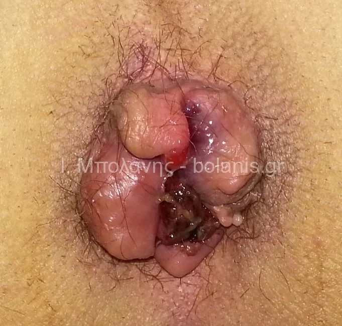 Hemorrhoids laser treatment - aimoroides prin 6
