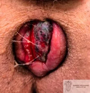 Case 2: grade 4 hemorrhoids with extensive thrombosis and necrosis - original image