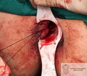 Case 2: plastic with absorbable sutures (MuRAL)