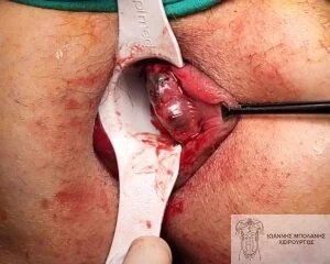 Case 2: clotted hemorrhoid