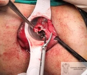 Case 2: thrombus resection with ultrasound scissors