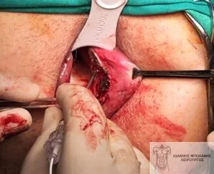 Case 2: laser application to the hemorrhoid