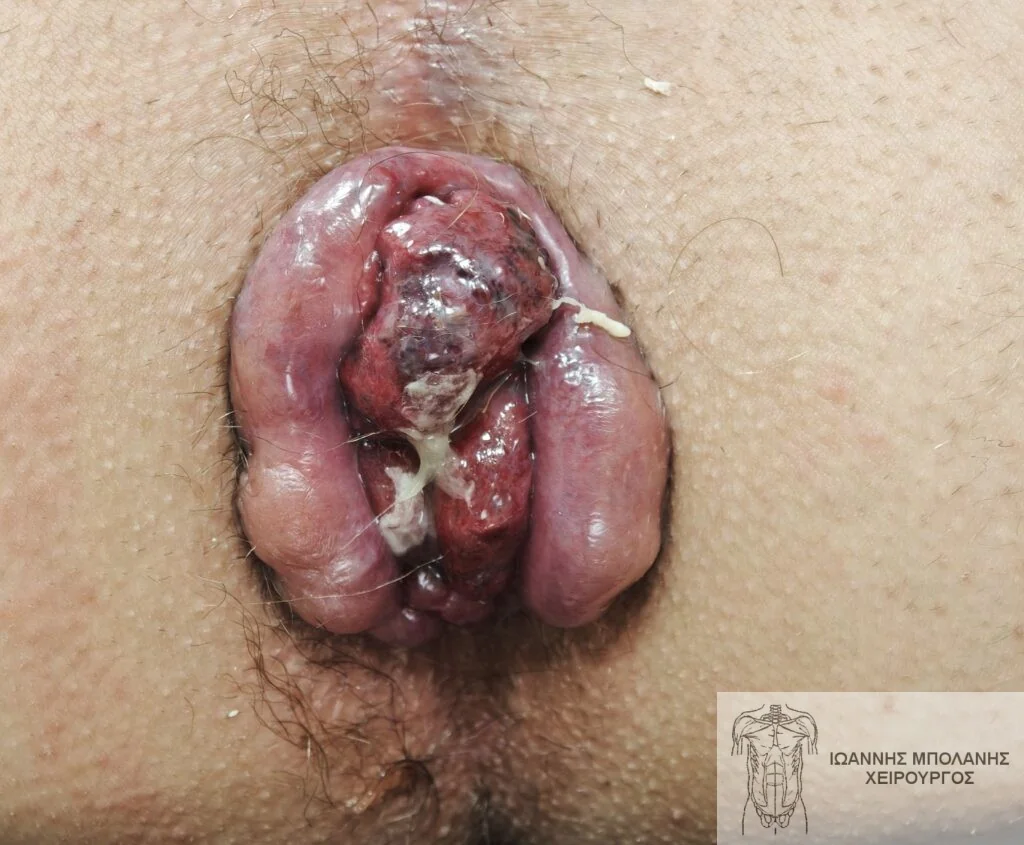 Case 1: grade 4 hemorrhoids with mild thrombosis LHP® - MuRAL