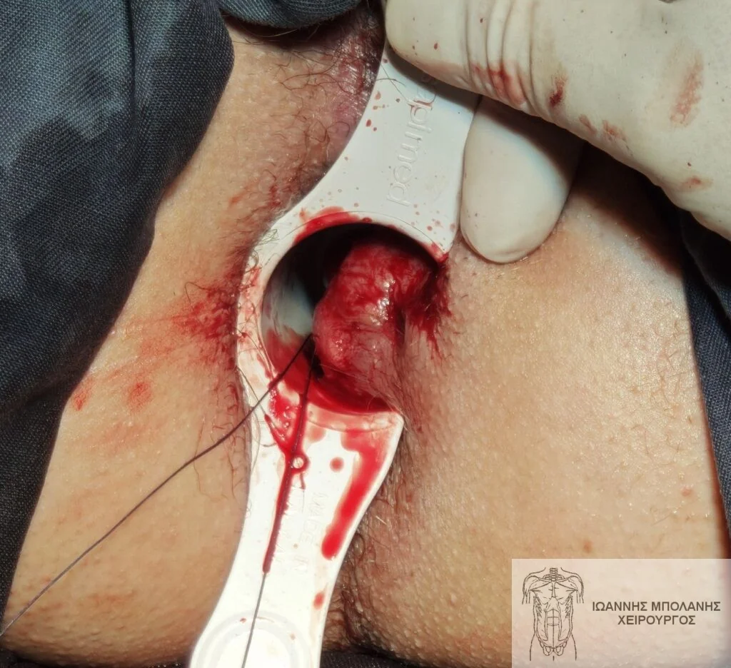 Case 1: rectal mucosa lift with absorbable MuRAL sutures
