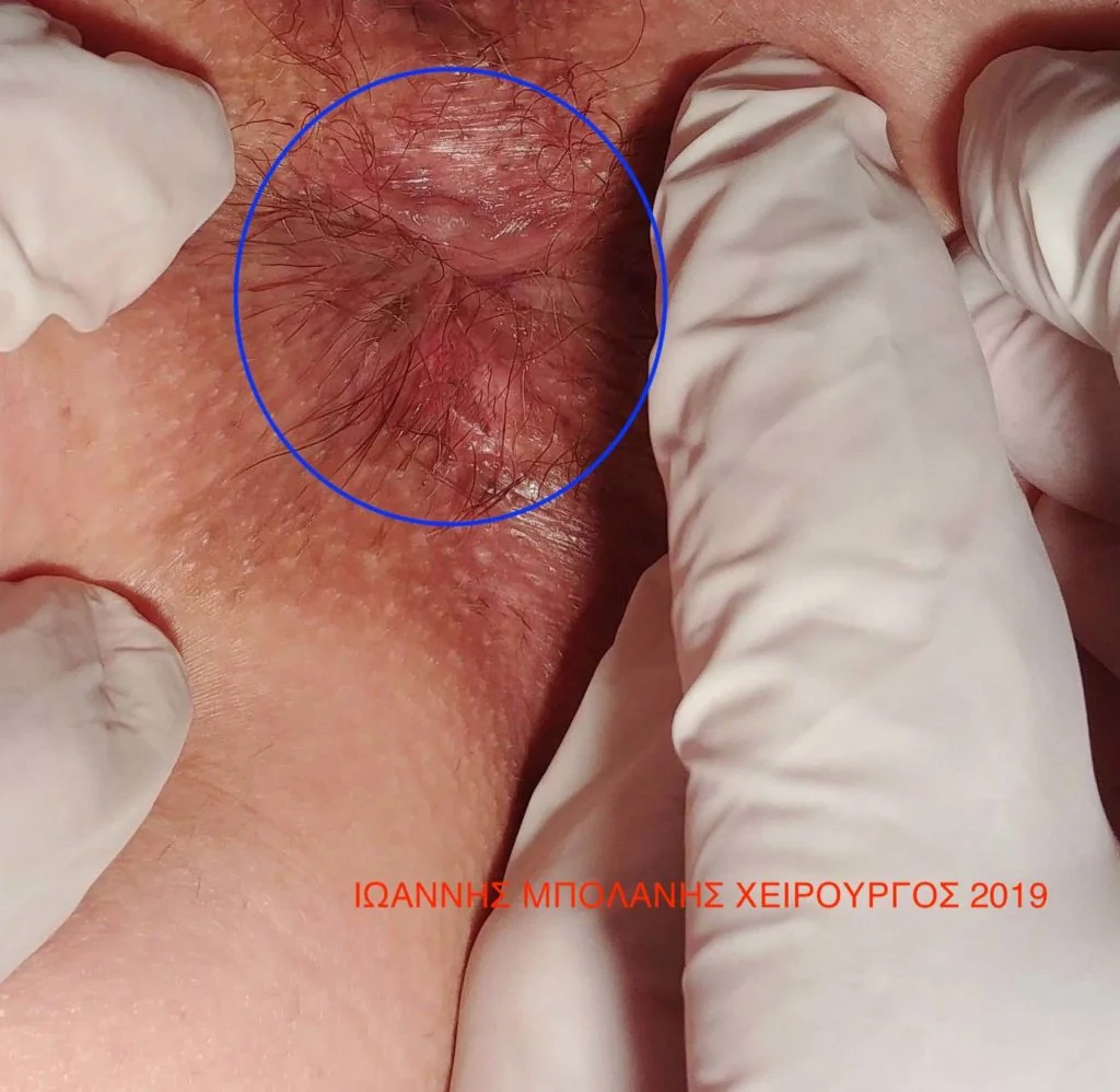 Haemorrhoidoplasty LHP®-RAR image after 1 month.