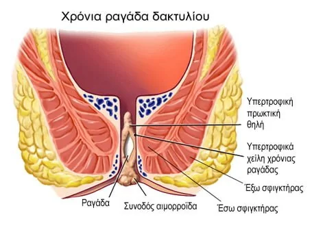 Χρόνια ραγάδα