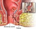 Peripheral fistula treatment with laser method FiLaC® laser