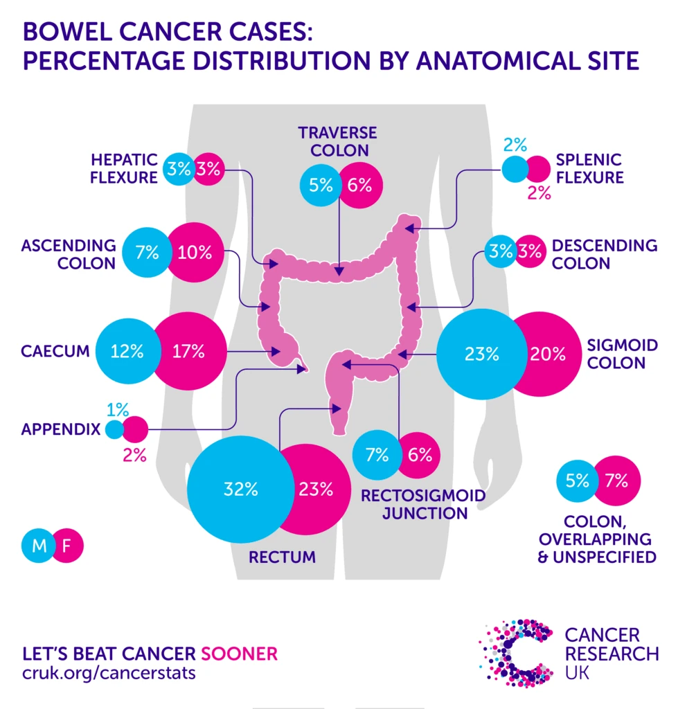 Colorectal cancer - detection