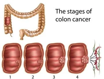 Bowel cancer near the sphincter