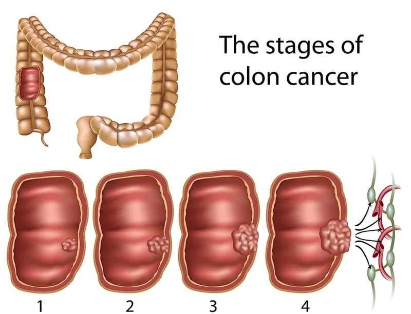  Rectal cancer stages.