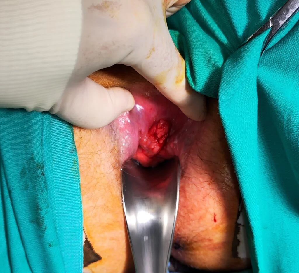 squamous cell rectal cancer