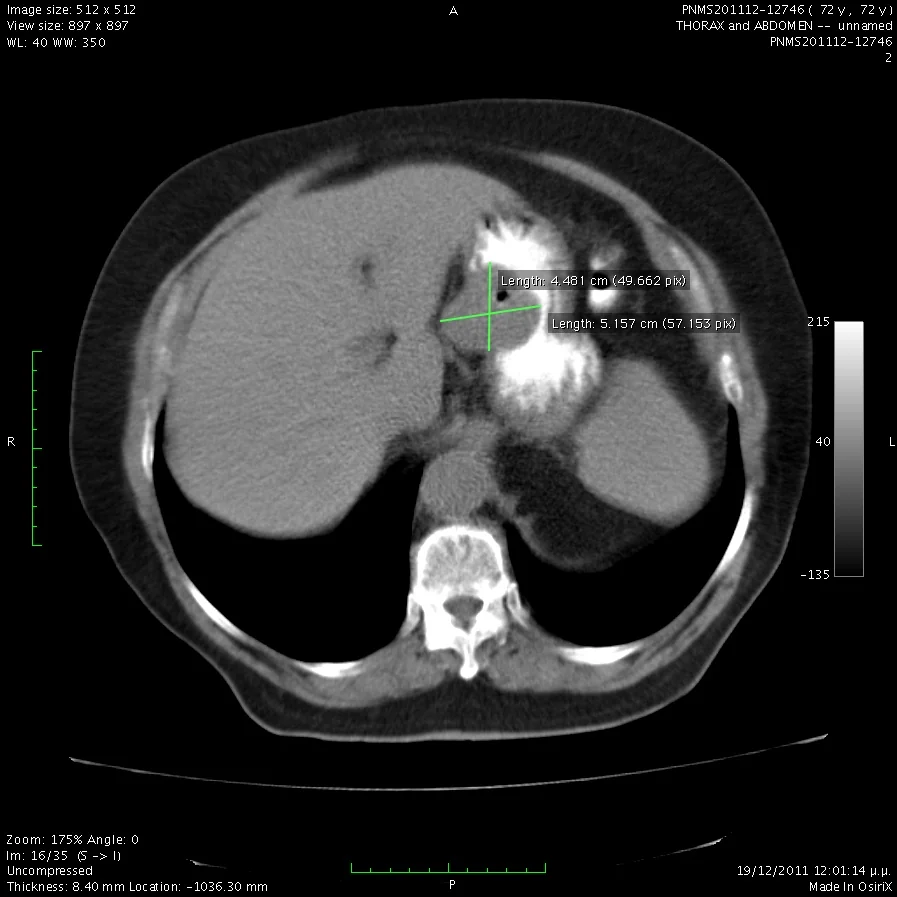 Stomach GIST stromal tumor