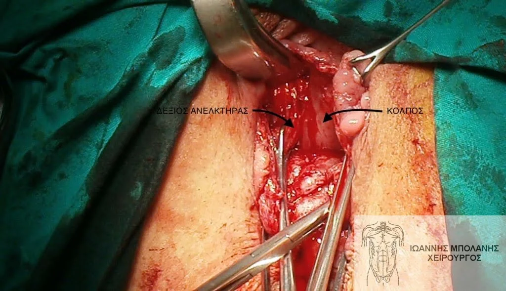 Incontinence clamp restoration - diatomi sfigktira 11 1