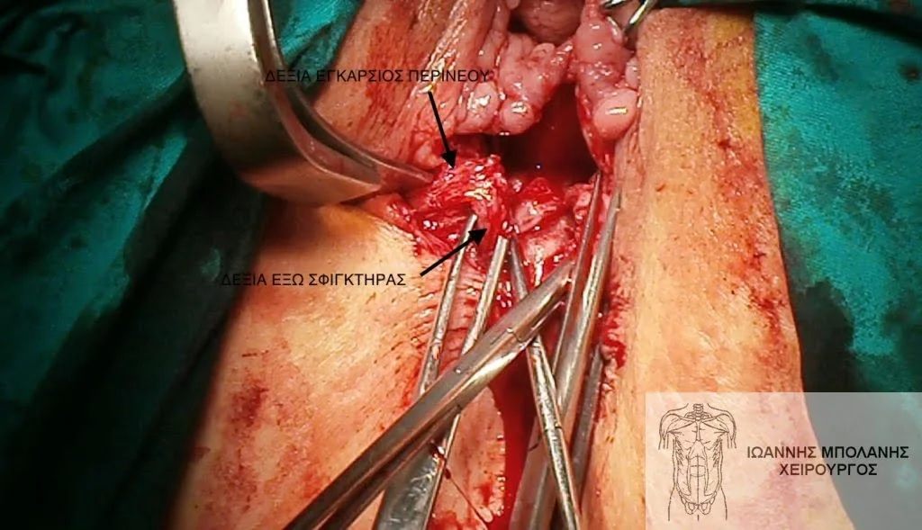 Incontinence clamp restoration - diatomi sfigktira 14