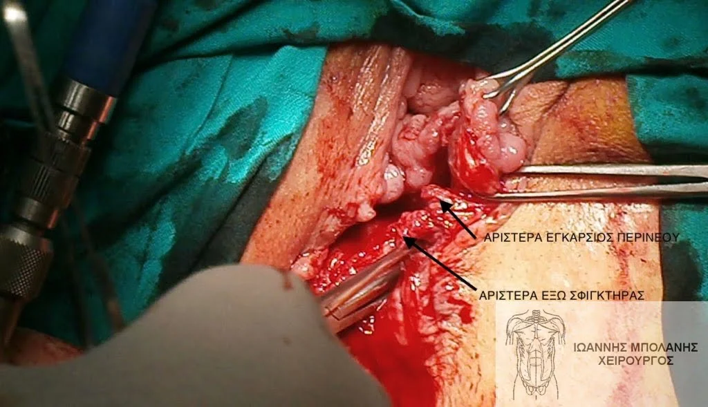 Incontinence clamp restoration - diatomi sfigktira 15