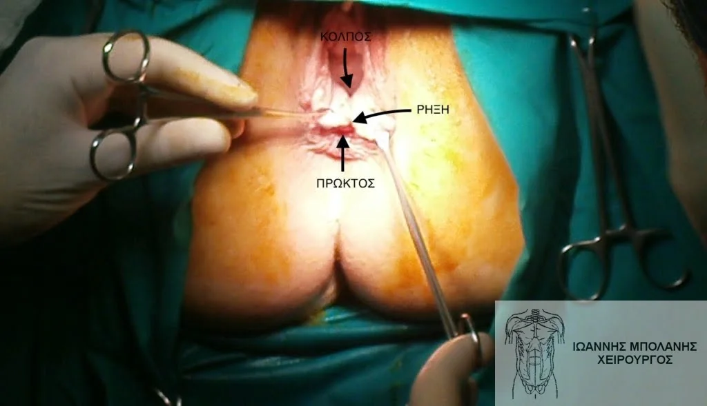 Incontinence clamp restoration - diatomi sfigktira 20