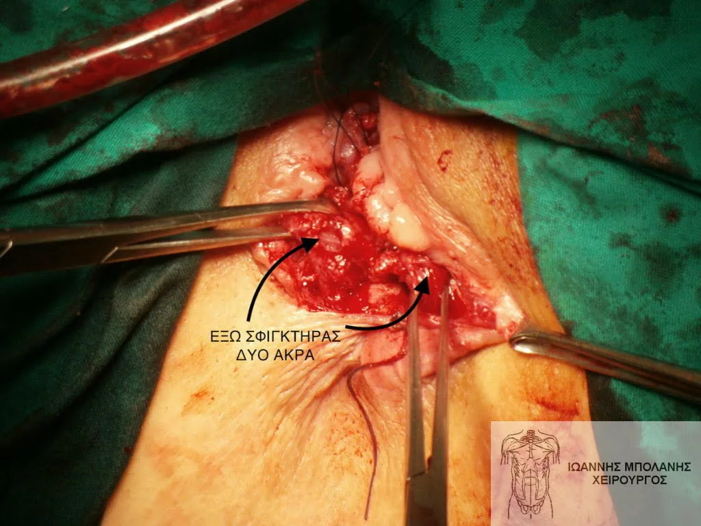 Incontinence clamp restoration - diatomi sfigktira 7 1