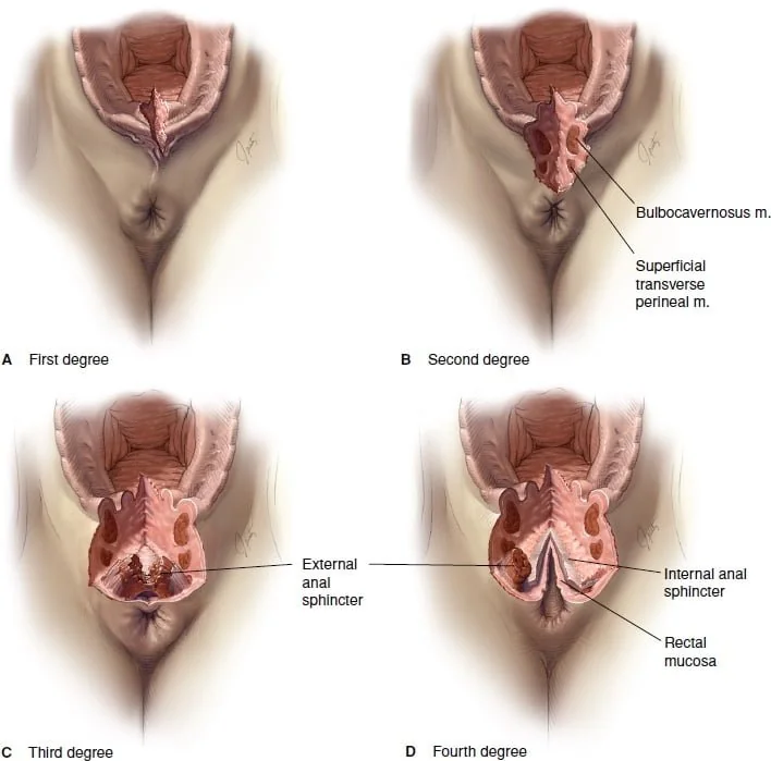 Incontinence clamp restoration - diatomi sfigktira draw 4