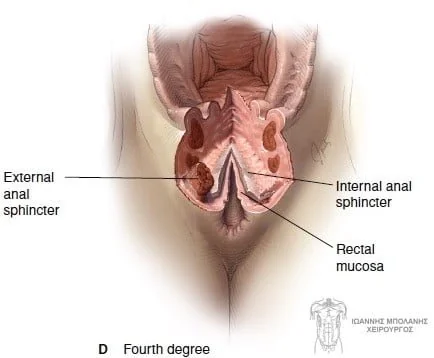 Incontinence clamp restoration - diatomi sfigktira draw 6