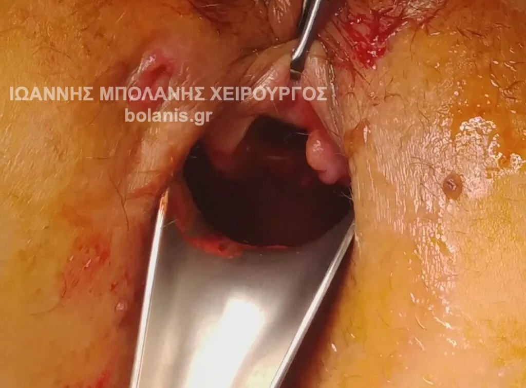 Bowel perforation repair after laser for periosteal fistula. - Dr. Ioannis Bolanis – Colorectal Surgeon - laser bowel perforation 1
