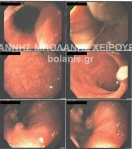 Bowel perforation repair after laser for periosteal fistula. - Dr. Ioannis Bolanis – Colorectal Surgeon - laser bowel perforation 10