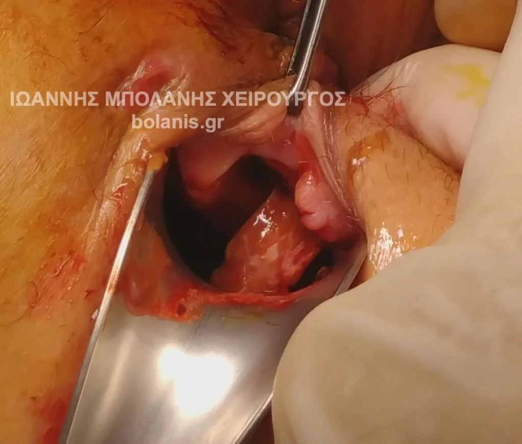 Bowel perforation repair after laser for periosteal fistula. - Dr. Ioannis Bolanis – Colorectal Surgeon - laser bowel perforation 2