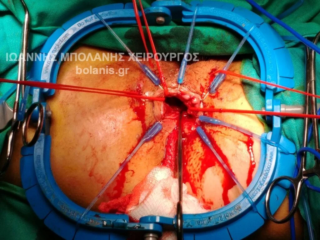 Periosteal fistula photos - laser bowel perforation 8