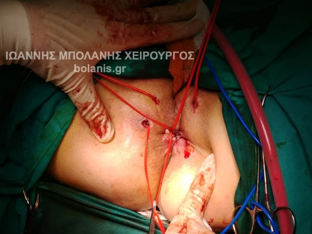 Periosteal fistula photos - laser bowel perforation 9