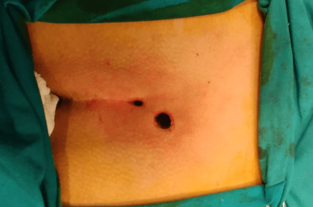 Coccyx cyst with laser new FiLaC® method after