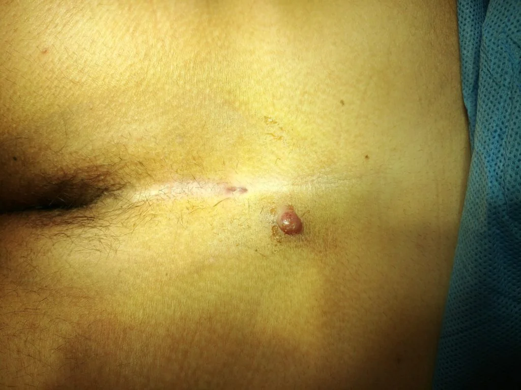 Coccyx cyst with laser new FiLaC® method before