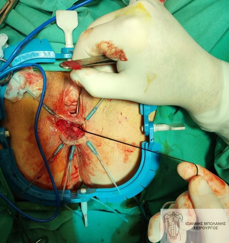 Martius flap ortovaginal fistula