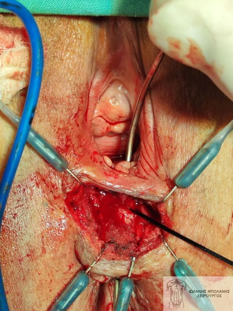 Peripheral fistula laser FiLaC® - fistula martius flap 2