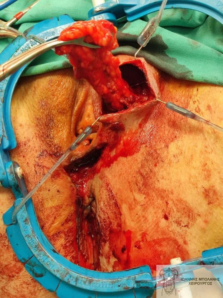 Peripheral fistula laser FiLaC® - fistula martius flap 3