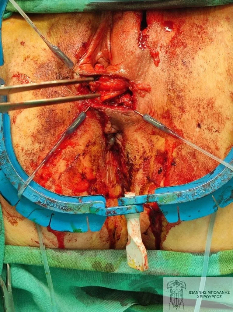 Peripheral fistula laser FiLaC® - fistula martius flap 4