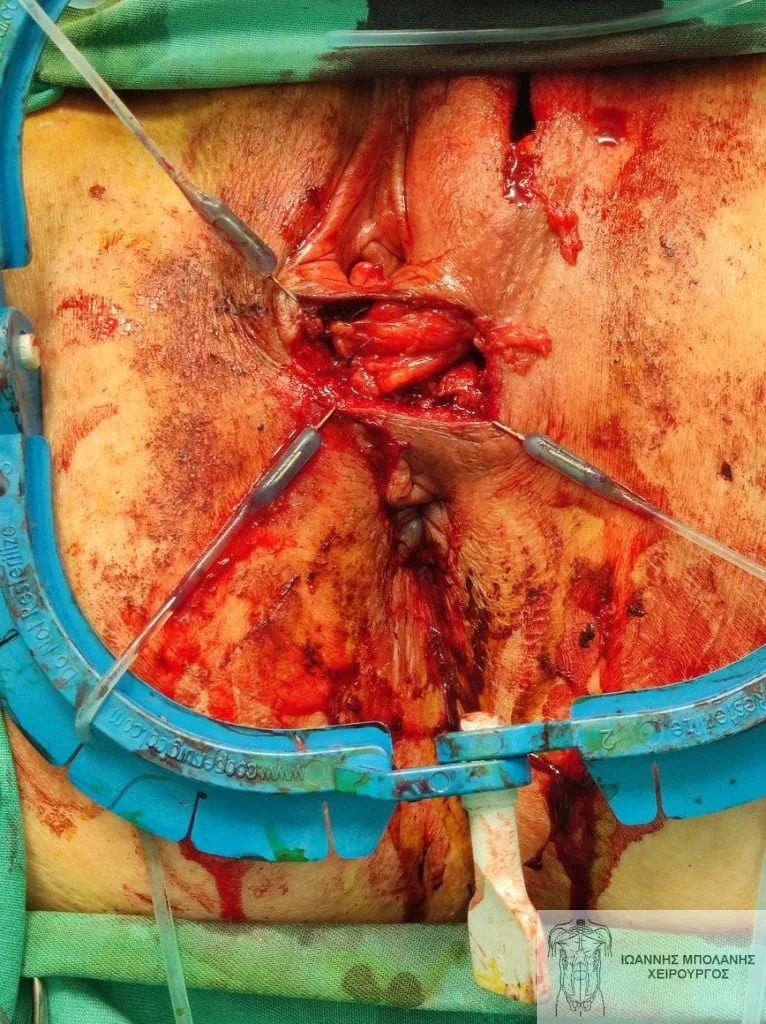 Peripheral fistula laser FiLaC® - fistula martius flap 5