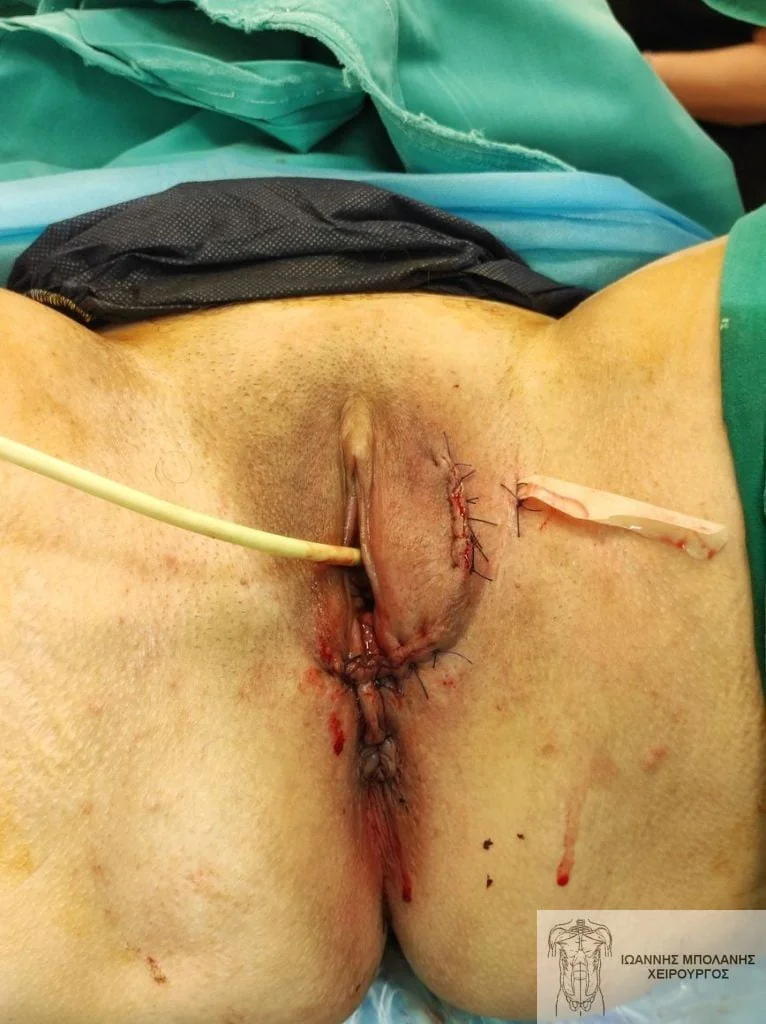 Peripheral fistula laser FiLaC® - fistula martius flap 7